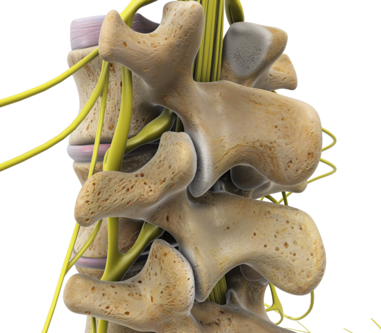 Lumbar Stenosis Before